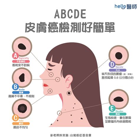 為什麼會長毛|痣形成的原因？痣長毛、痣變多變大是痣病變？5招判別